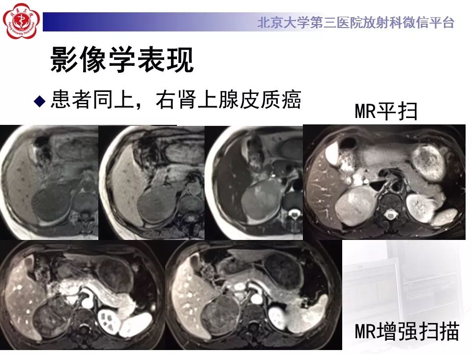 【病例】肾上腺皮质腺癌1例CT及MR影像表现