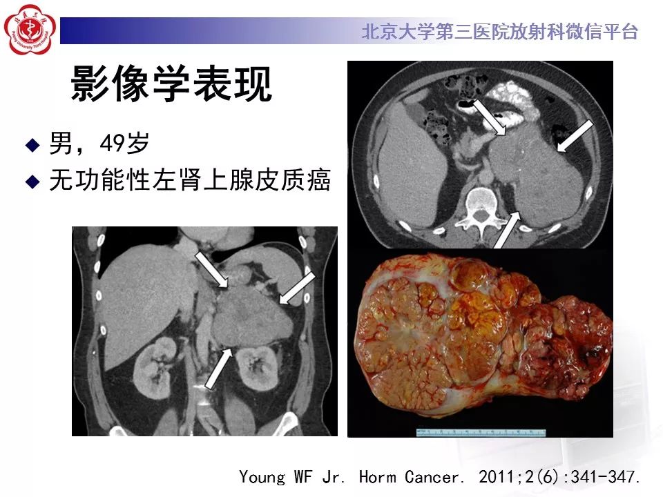【病例】肾上腺皮质腺癌1例CT及MR影像表现