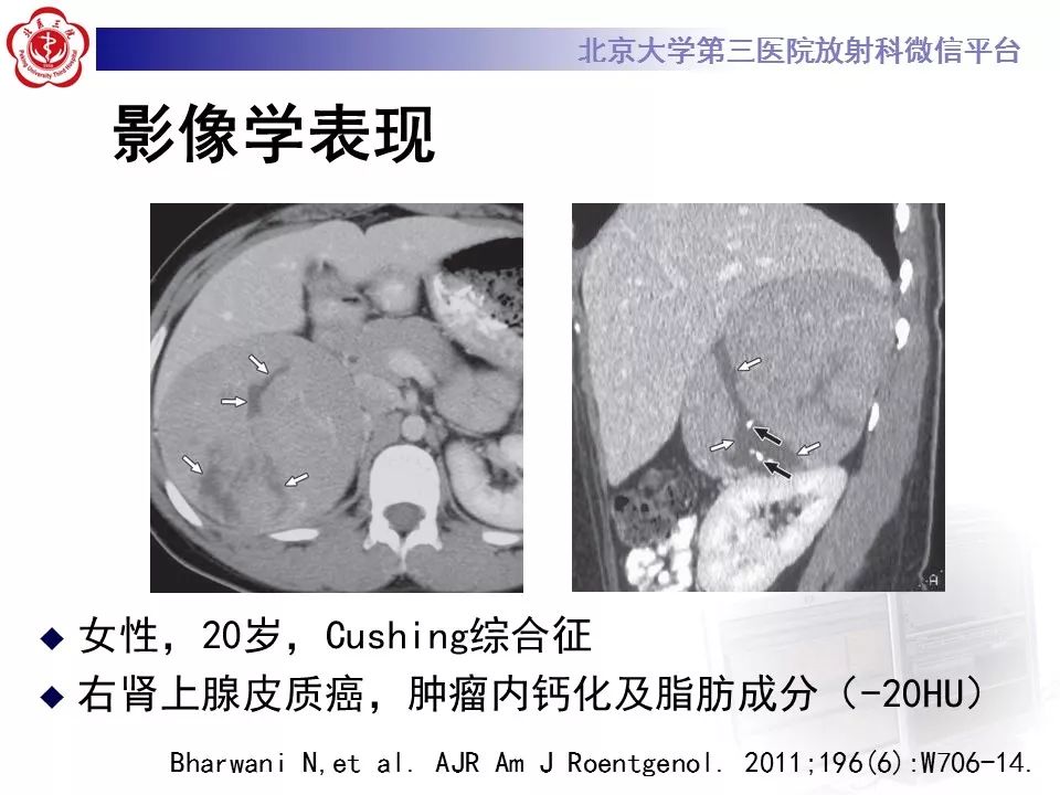 【病例】肾上腺皮质腺癌1例CT及MR影像表现