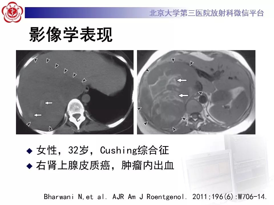 【病例】肾上腺皮质腺癌1例CT及MR影像表现