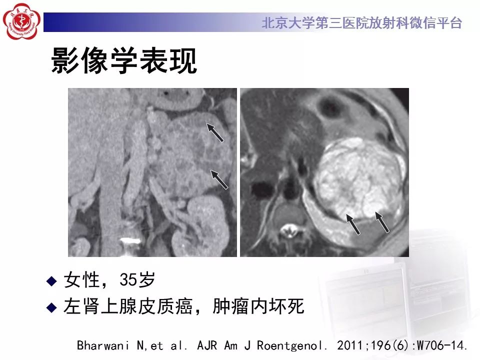 【病例】肾上腺皮质腺癌1例CT及MR影像表现