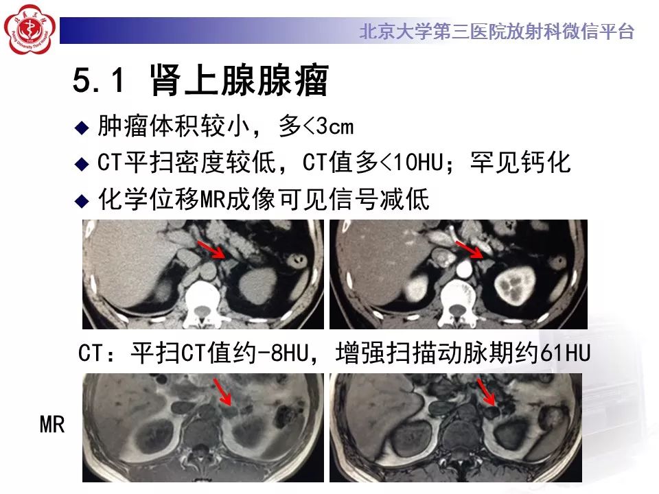 【病例】肾上腺皮质腺癌1例CT及MR影像表现
