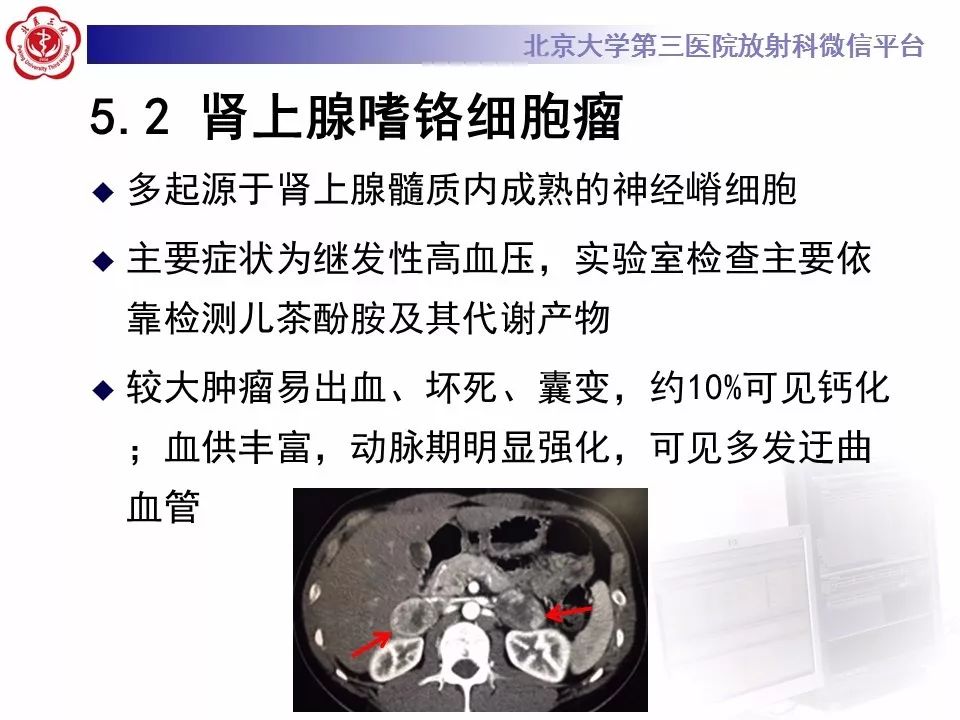 【病例】肾上腺皮质腺癌1例CT及MR影像表现