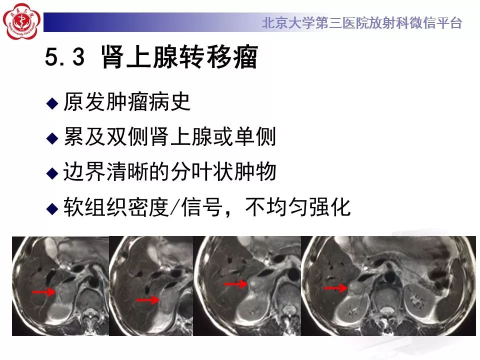 【病例】肾上腺皮质腺癌1例CT及MR影像表现