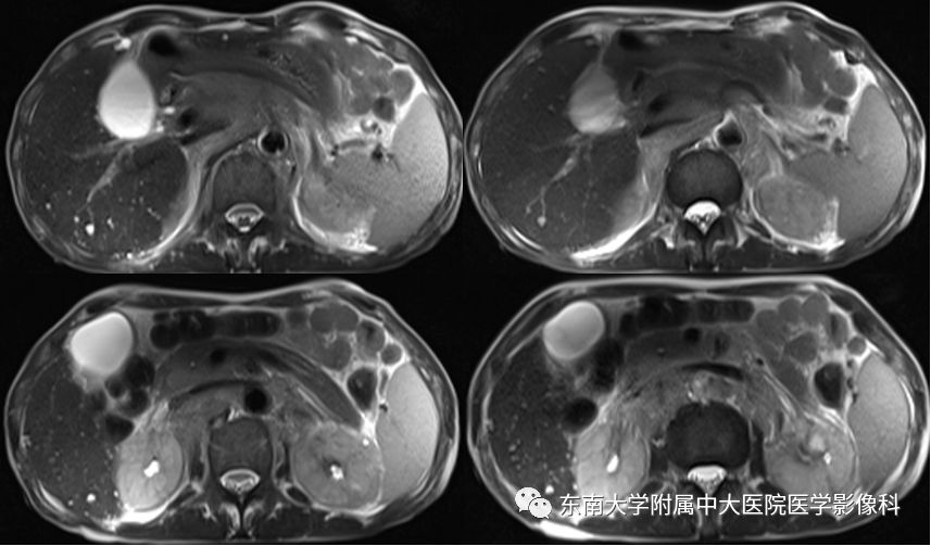 【病例】腹膜后淋巴瘤1例MR影像表现