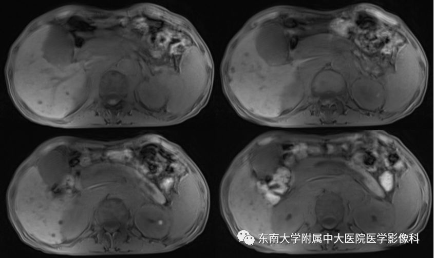 【病例】腹膜后淋巴瘤1例MR影像表现