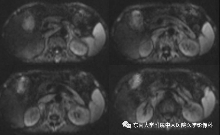 【病例】腹膜后淋巴瘤1例MR影像表现