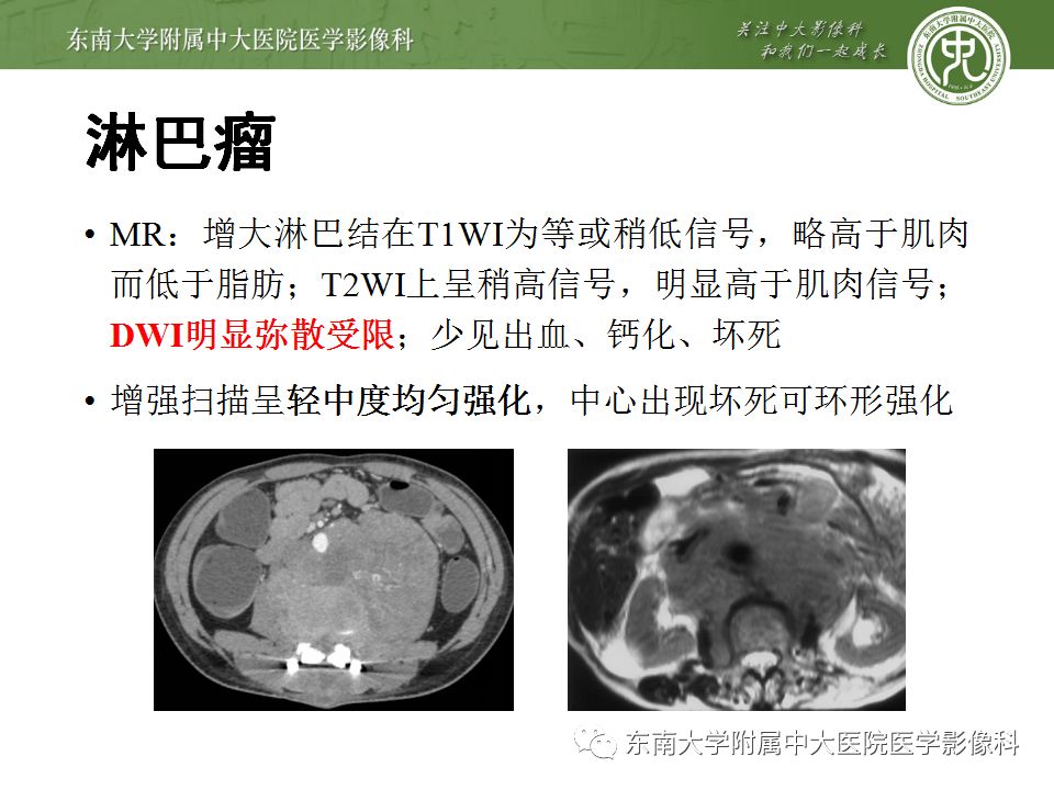 【病例】腹膜后淋巴瘤1例MR影像表现