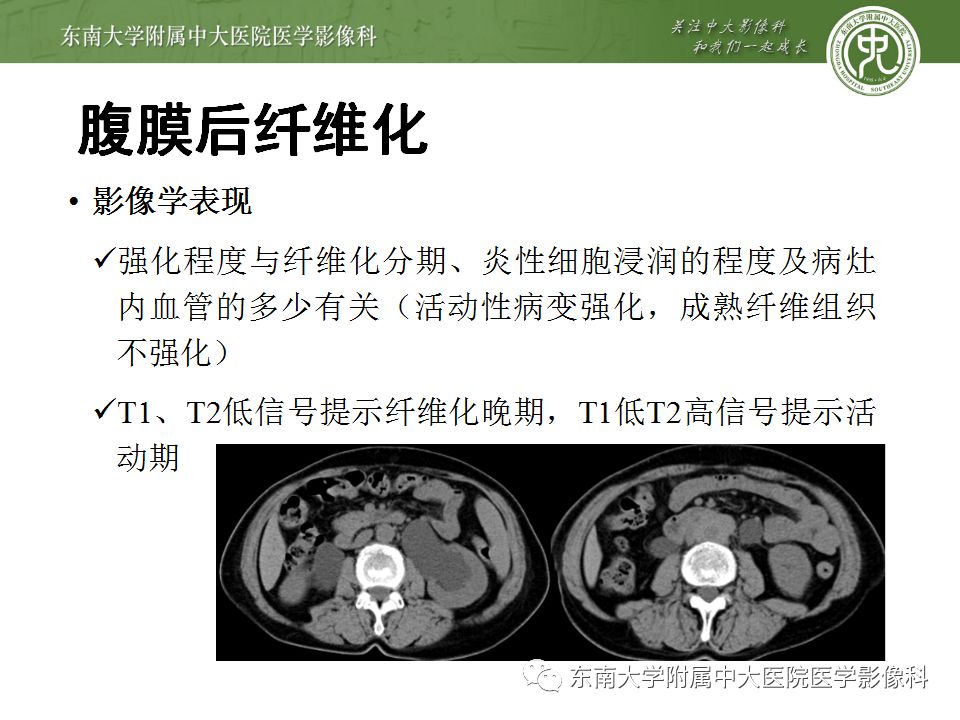 【病例】腹膜后淋巴瘤1例MR影像表现