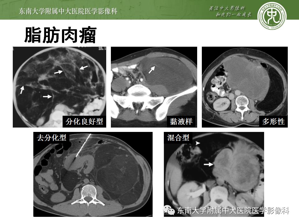 【病例】腹膜后淋巴瘤1例MR影像表现