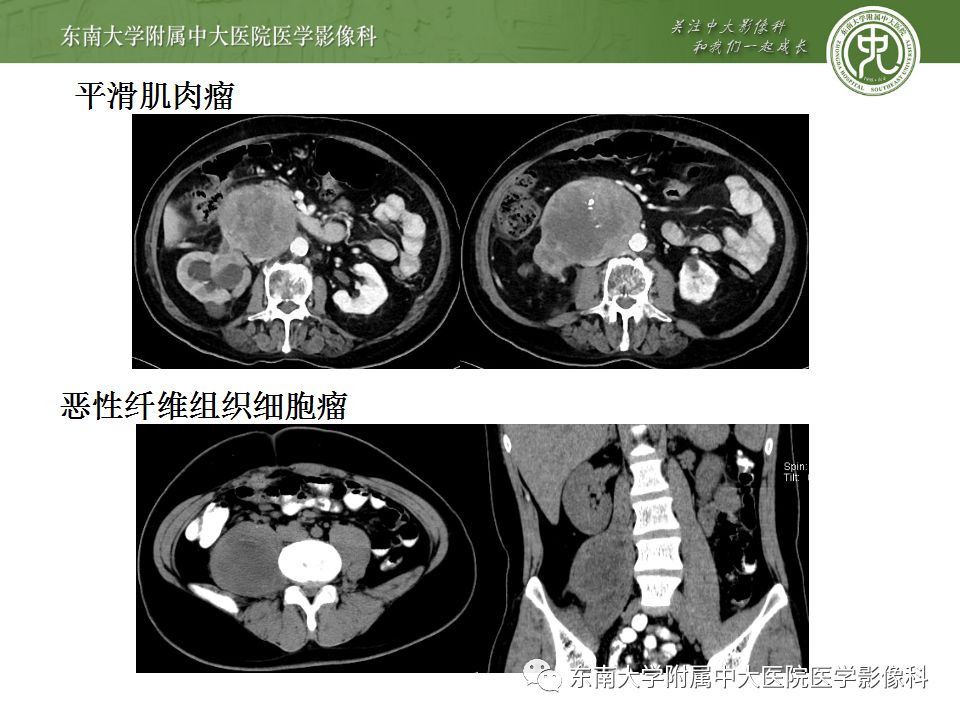 【病例】腹膜后淋巴瘤1例MR影像表现