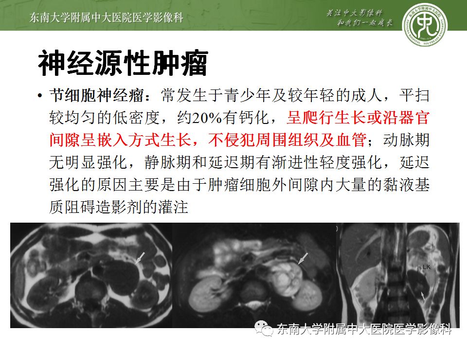 【病例】腹膜后淋巴瘤1例MR影像表现