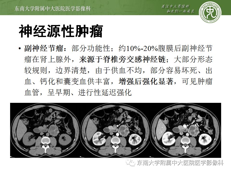 【病例】腹膜后淋巴瘤1例MR影像表现