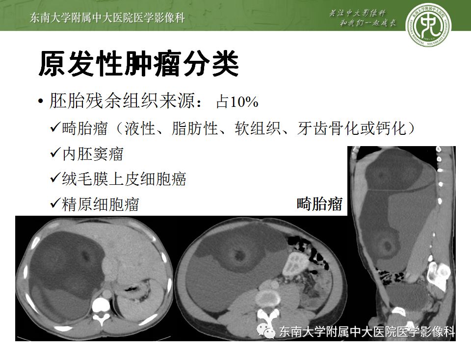 【病例】腹膜后淋巴瘤1例MR影像表现