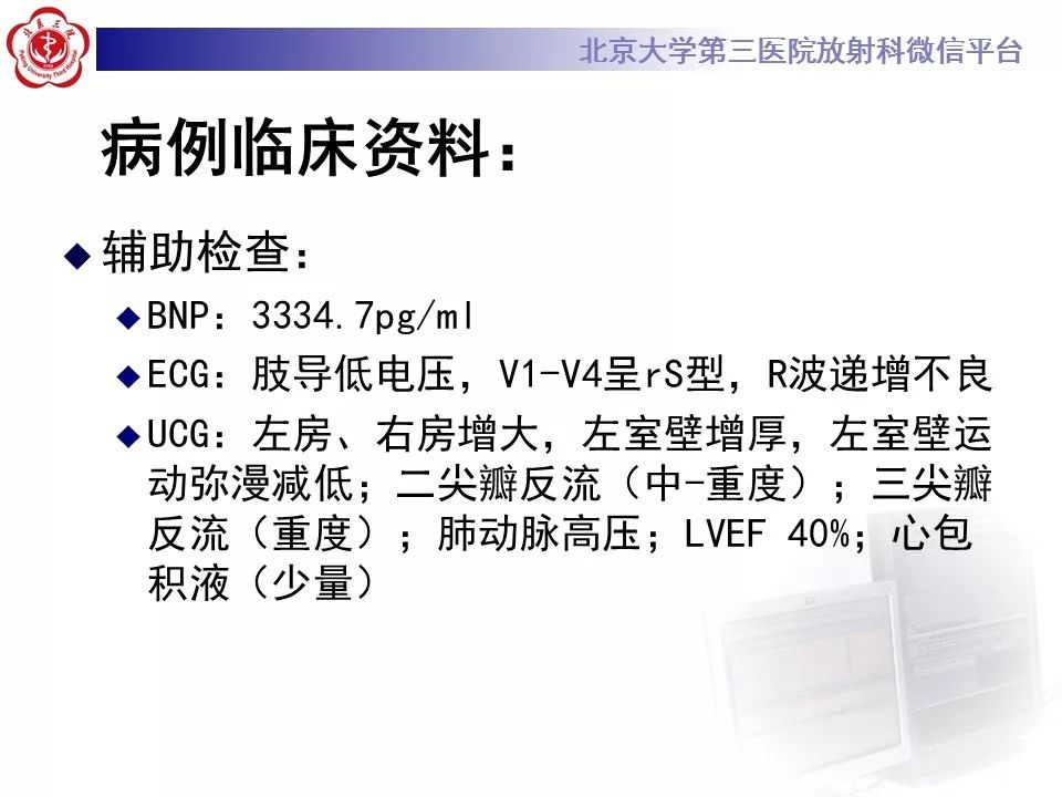 【病例】心肌淀粉样变性1例MR影像表现