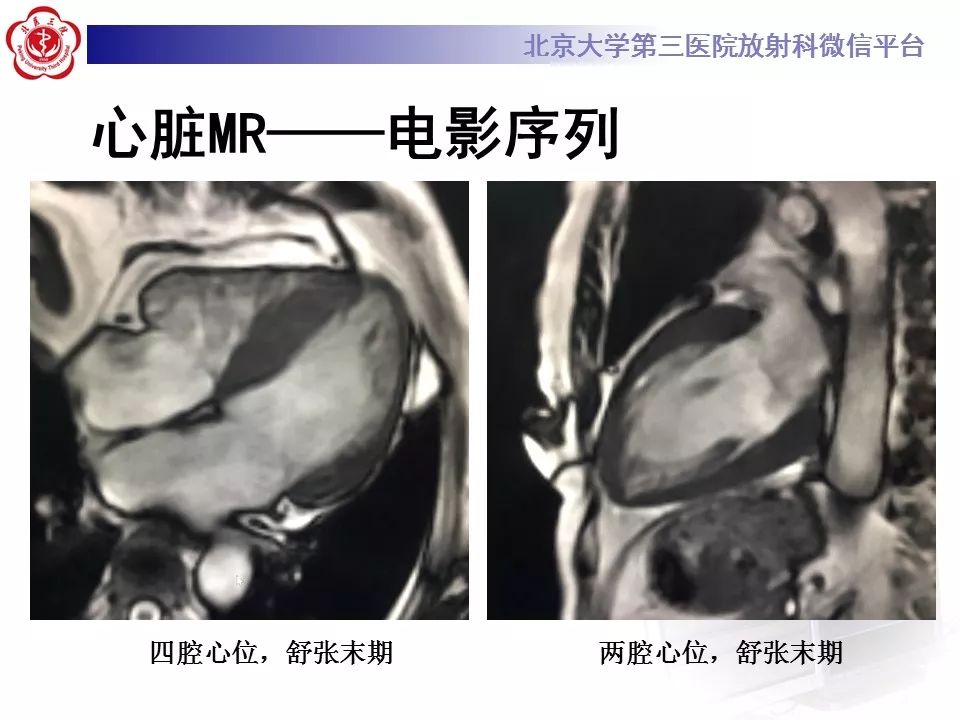 【病例】心肌淀粉样变性1例MR影像表现