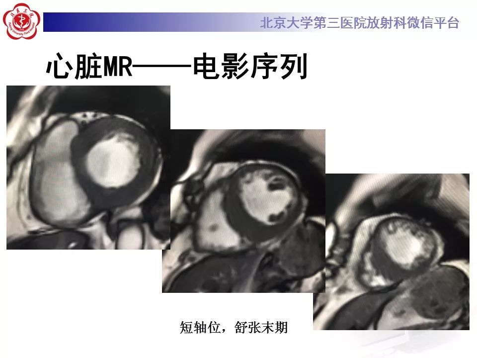 【病例】心肌淀粉样变性1例MR影像表现