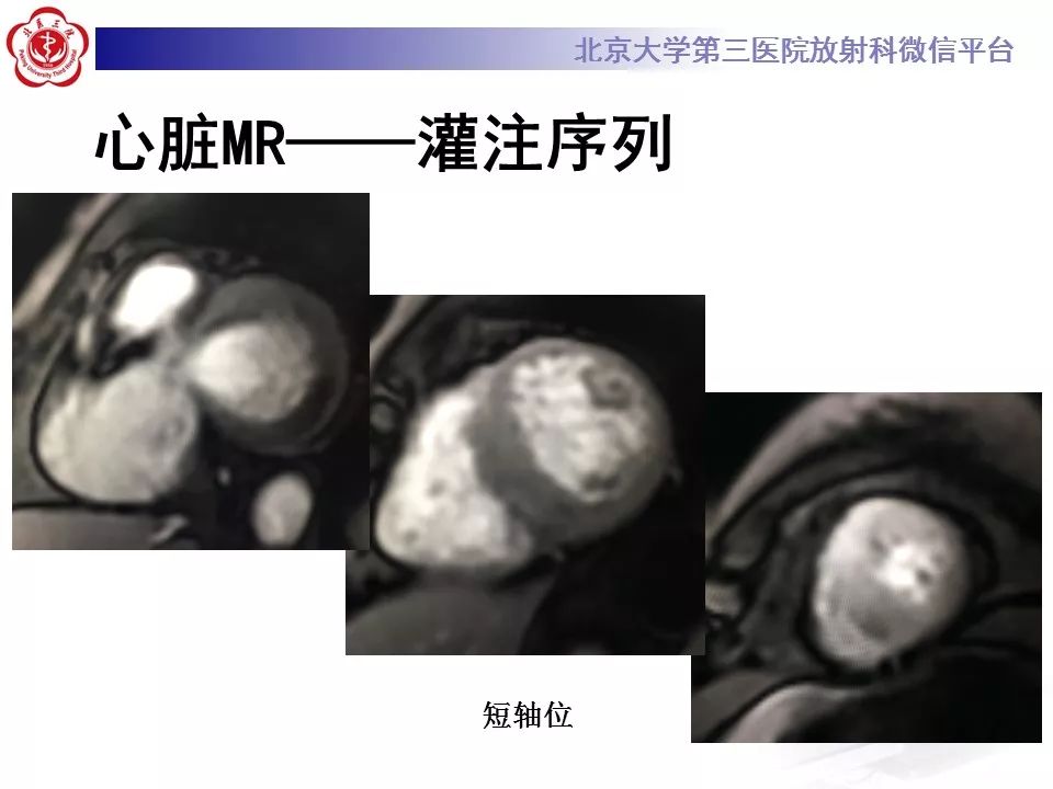 【病例】心肌淀粉样变性1例MR影像表现