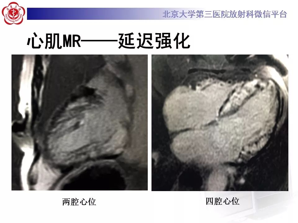 【病例】心肌淀粉样变性1例MR影像表现