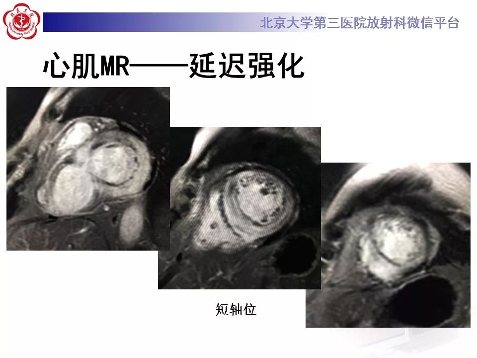 【病例】心肌淀粉样变性1例MR影像表现