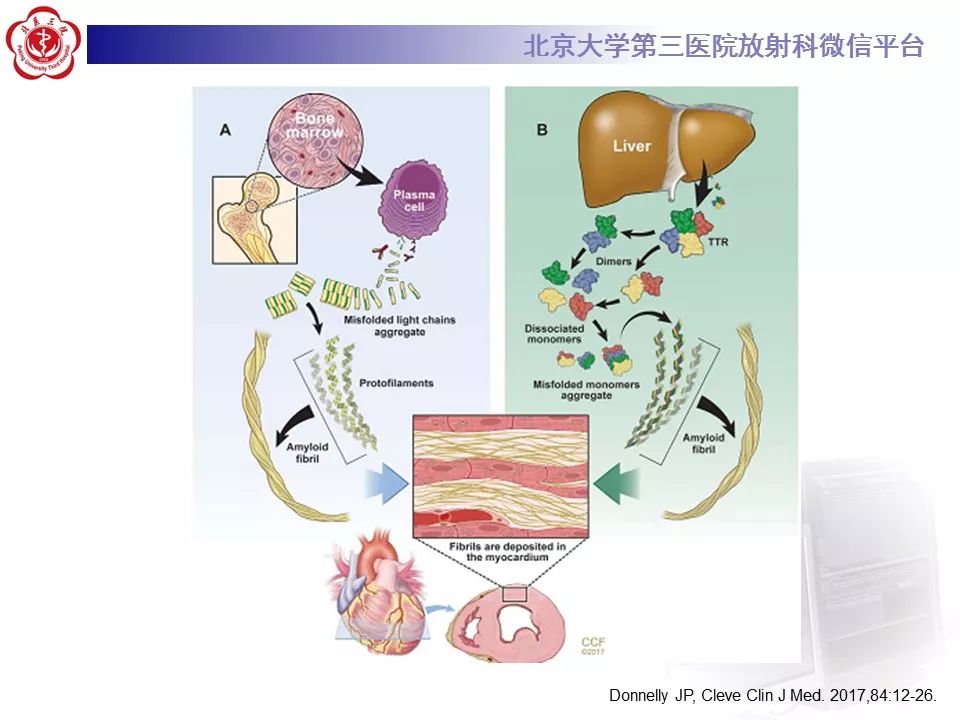 【病例】心肌淀粉样变性1例MR影像表现