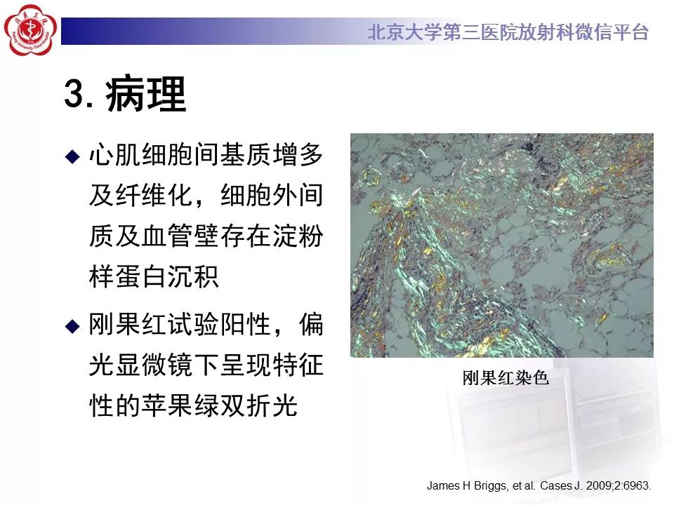 【病例】心肌淀粉样变性1例MR影像表现