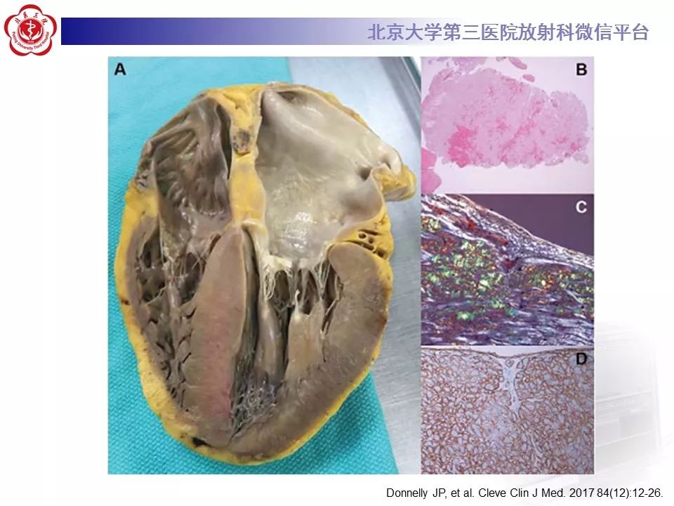 【病例】心肌淀粉样变性1例MR影像表现