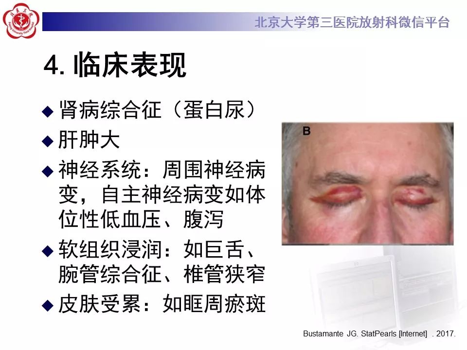 【病例】心肌淀粉样变性1例MR影像表现