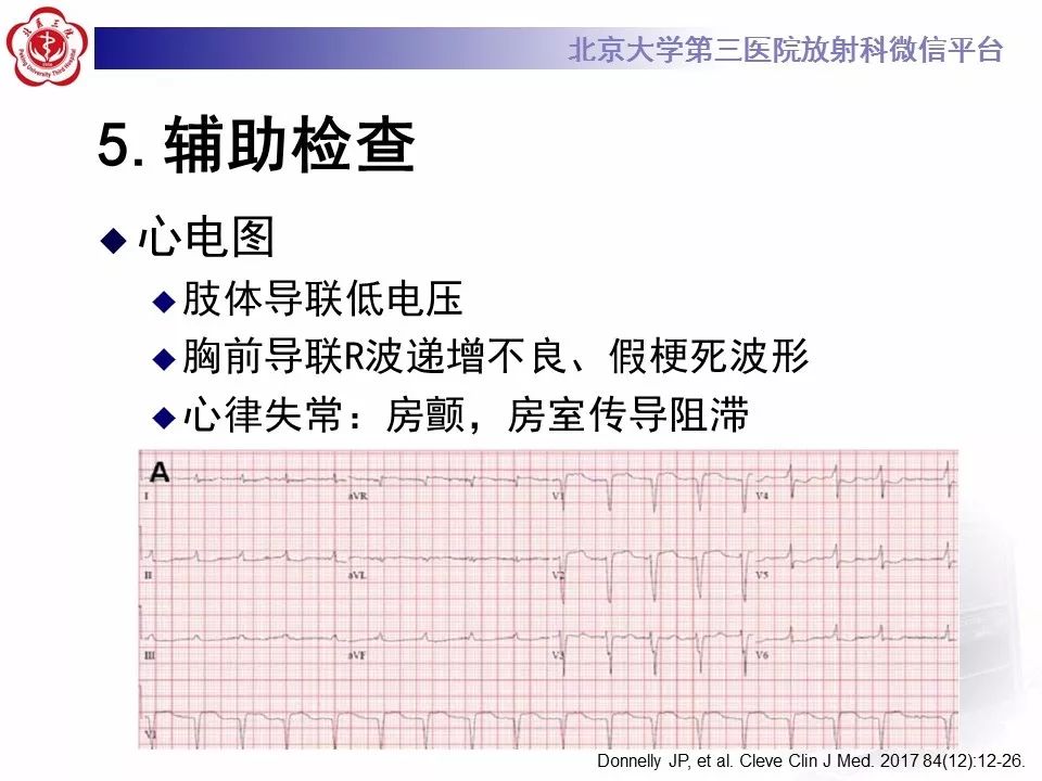 【病例】心肌淀粉样变性1例MR影像表现