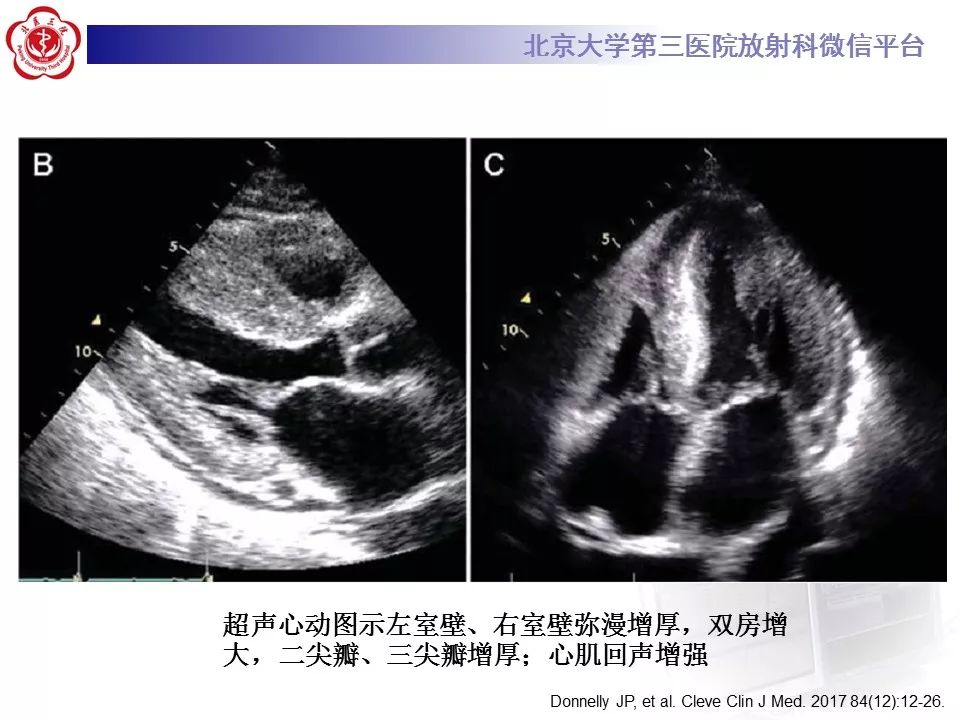 【病例】心肌淀粉样变性1例MR影像表现