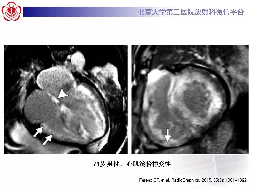 【病例】心肌淀粉样变性1例MR影像表现