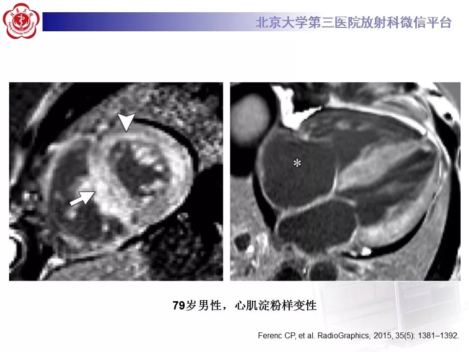 【病例】心肌淀粉样变性1例MR影像表现