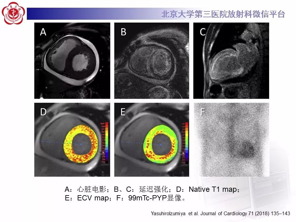 【病例】心肌淀粉样变性1例MR影像表现