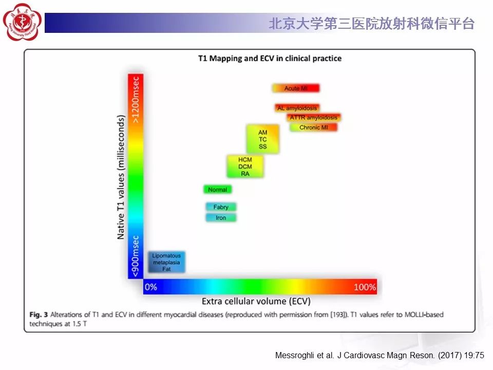 【病例】心肌淀粉样变性1例MR影像表现