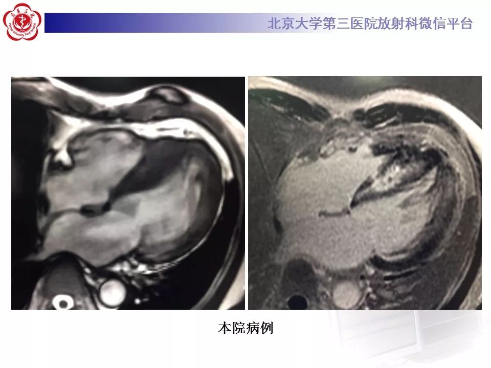 【病例】心肌淀粉样变性1例MR影像表现