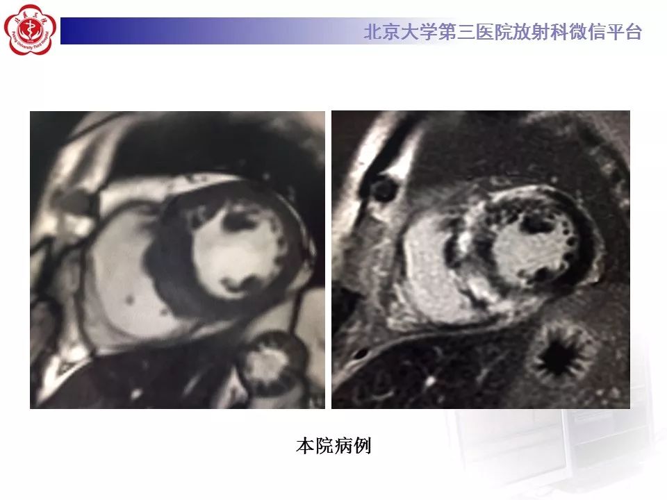 【病例】心肌淀粉样变性1例MR影像表现