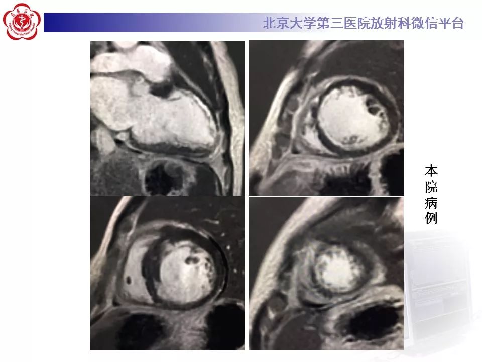 【病例】心肌淀粉样变性1例MR影像表现