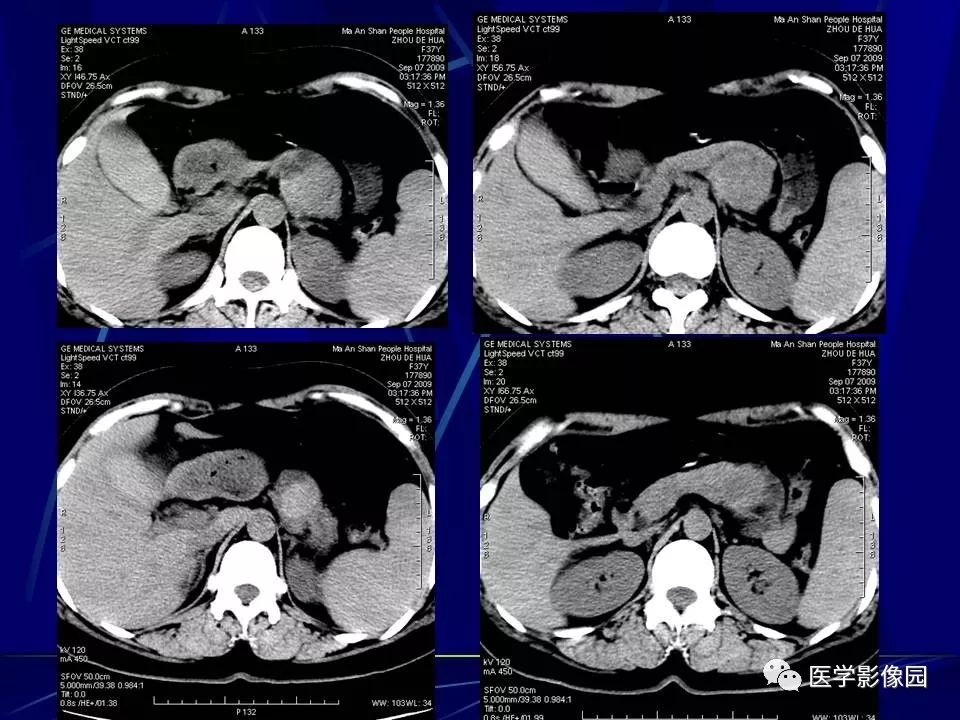 【病例】胰腺实性假乳头状瘤1例CT影像表现