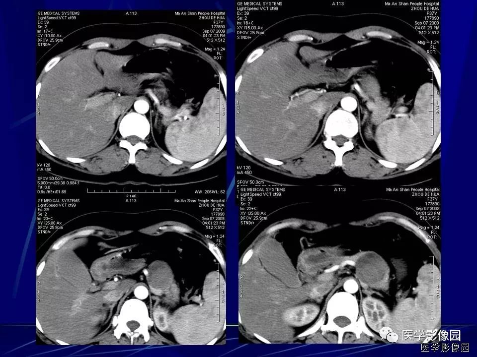 【病例】胰腺实性假乳头状瘤1例CT影像表现