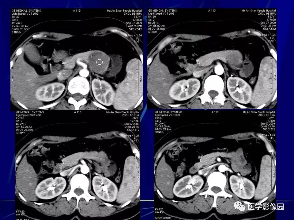 【病例】胰腺实性假乳头状瘤1例CT影像表现