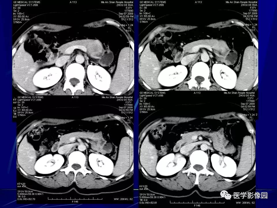 【病例】胰腺实性假乳头状瘤1例CT影像表现