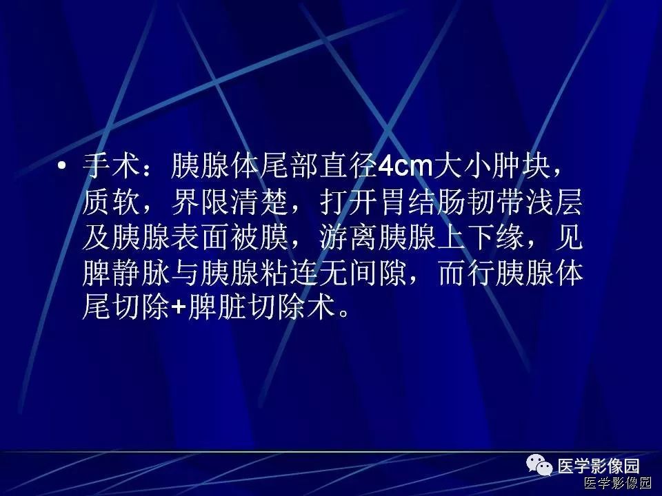 【病例】胰腺实性假乳头状瘤1例CT影像表现