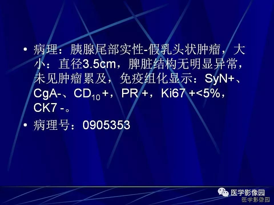 【病例】胰腺实性假乳头状瘤1例CT影像表现