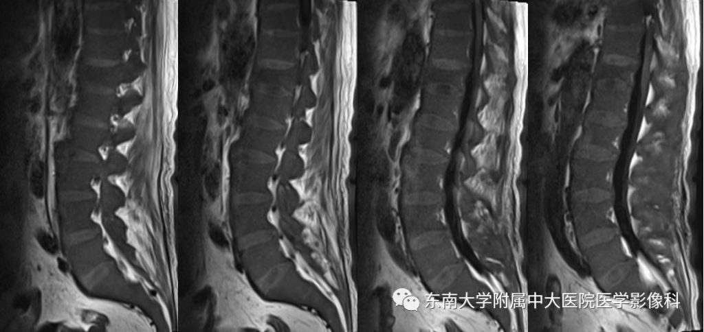 【病例】白血病骨髓浸润1例MR影像表现