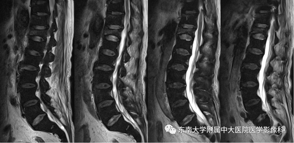 【病例】白血病骨髓浸润1例MR影像表现 【病例】白血病骨髓浸润1例MR影像表现