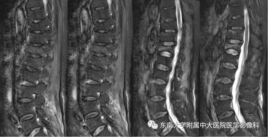 【病例】白血病骨髓浸润1例MR影像表现 【病例】白血病骨髓浸润1例MR影像表现