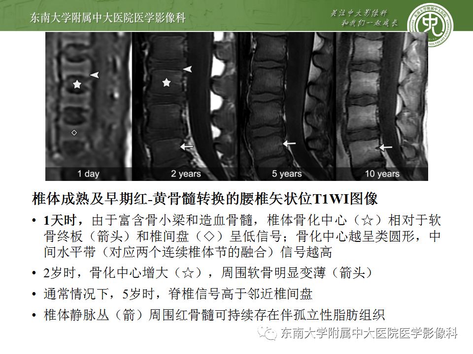 【病例】白血病骨髓浸润1例MR影像表现 【病例】白血病骨髓浸润1例MR影像表现
