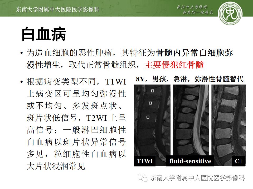 【病例】白血病骨髓浸润1例MR影像表现 【病例】白血病骨髓浸润1例MR影像表现