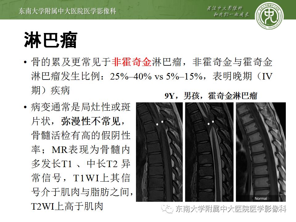 【病例】白血病骨髓浸润1例MR影像表现 【病例】白血病骨髓浸润1例MR影像表现