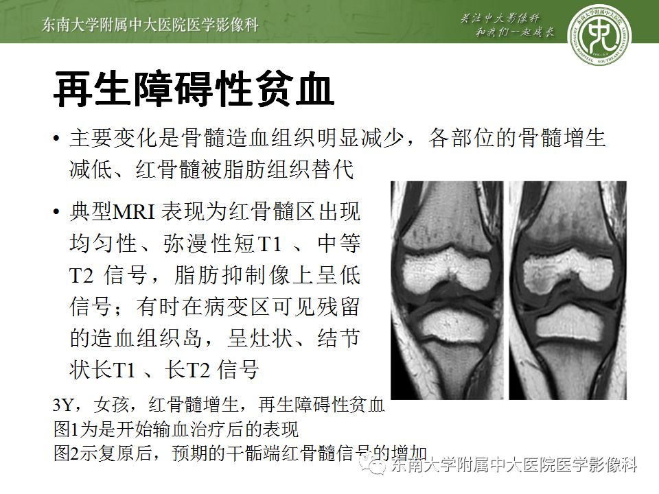 【病例】白血病骨髓浸润1例MR影像表现 【病例】白血病骨髓浸润1例MR影像表现